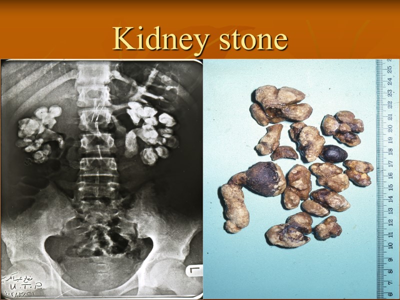 Kidney stone